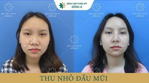 Trước và sau nâng mũi tại Đông Á