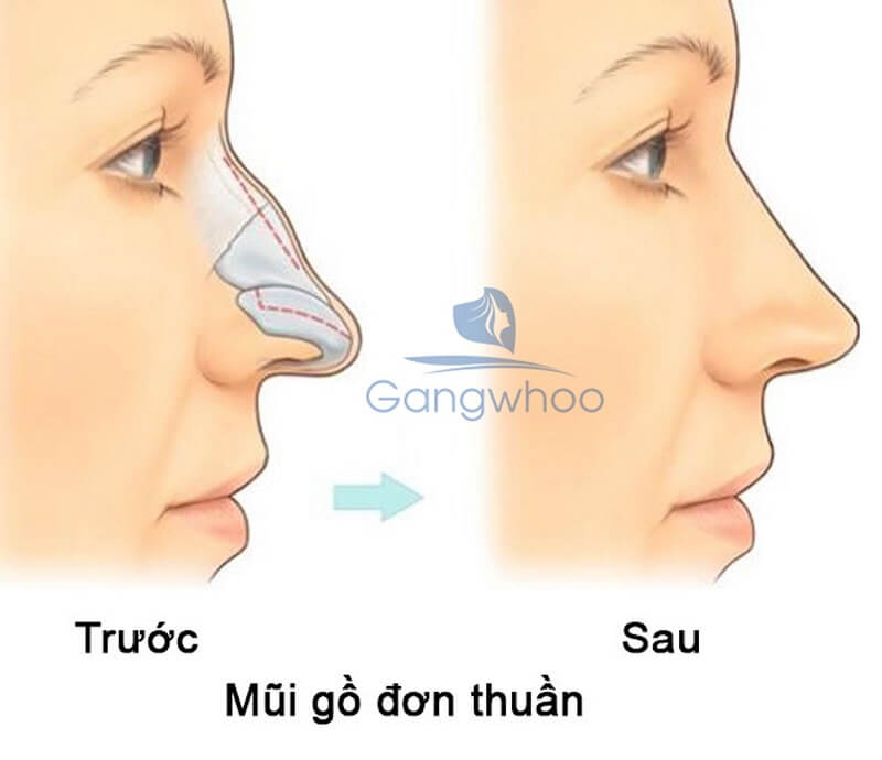 gọt xương mũi tại TMV Gangwhoo