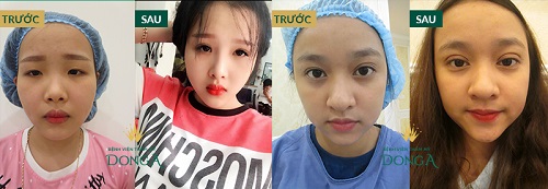 Mắt cao và thấp là gì, đẹp hay xấu, cách khắc phục? 5 Mắt cao và thấp là gì, đẹp hay xấu, cách khắc phục? 5