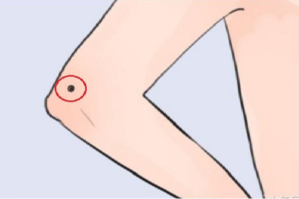 Nốt ruồi trên khuỷu tay trái - nghĩa là gì?  Tốt hay xấu? 