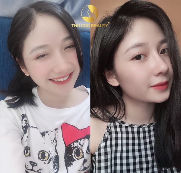 Dáng mũi củ tỏi như thế nào? Cách sửa mũi bằng củ tỏi hiệu quả? 11 dài hạn