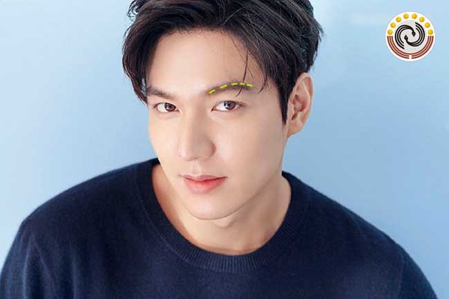 Xương chân mày lộ xương chân mày là bệnh gì? Đặc điểm nhận dạng là gì?