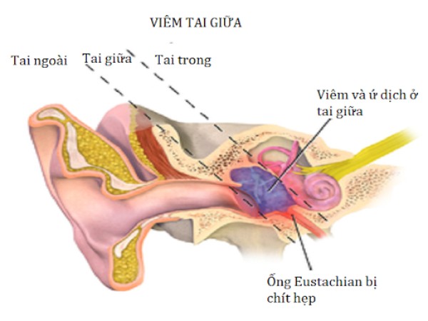 Tắc ống eustachian trong viêm tai giữa